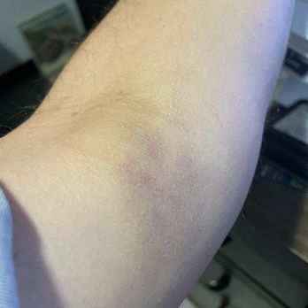 Atria Mobile Blood Draw - Bruised arm after multiple sticks and inability to locate the vein. - Blood & Plasma Donation Centers Near Me Atria Mobile Blood Draw - Bruised arm after multiple sticks and inability to locate the vein. - Blood & Plasma Donation Centers Near Me