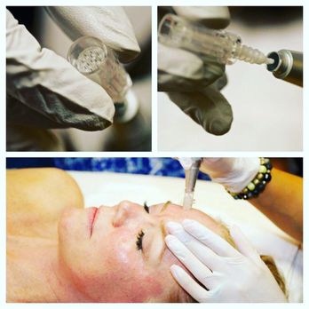Pure Skin Bar - A single sterile tip is used to perform a microneedling treatment for the face and different areas of the body. - Skin Care Near Me - Phoenix, Arizona Pure Skin Bar - A single sterile tip is used to perform a microneedling treatment for the face and different areas of the body. - Skin Care Near Me - Phoenix, Arizona
