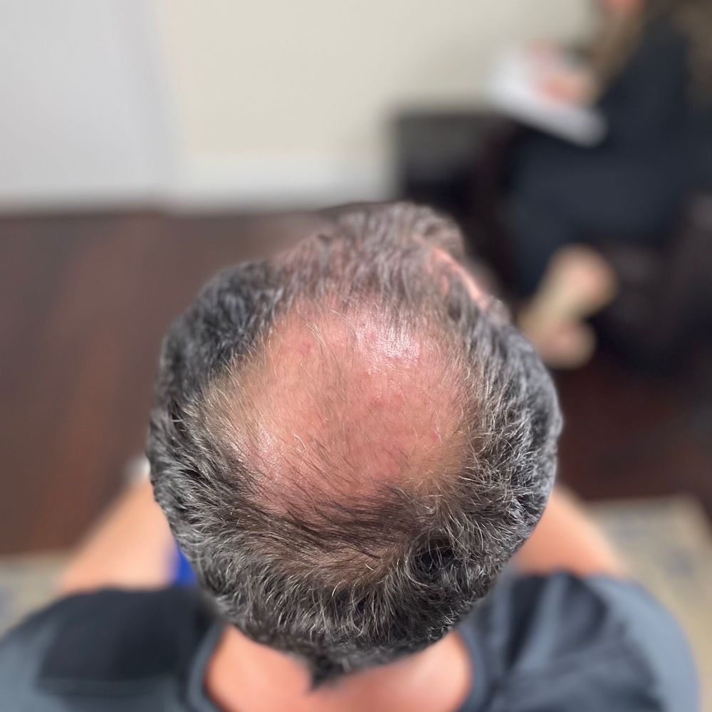 Aggregate 145+ jupiter hair transplant best tnbvietnam.edu.vn