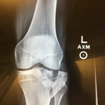 ProActive Physical Therapy - My Tibial Plateau Fracture - Physical Therapy Near Me - Redmond, Washington ProActive Physical Therapy - My Tibial Plateau Fracture - Physical Therapy Near Me - Redmond, Washington