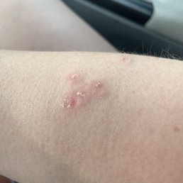 Bed bugs