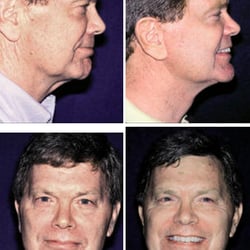 Ronald E Iverson, MD, FACS - Before & After Facelift