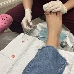 Empire Foot and Ankle Center - Toe nail removal