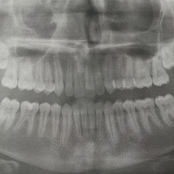 Parle Orthodontics - 17 year old after Dr Parle finished with invisialine - Orthodontists Near Me - Simi Valley, California Parle Orthodontics - 17 year old after Dr Parle finished with invisialine - Orthodontists Near Me - Simi Valley, California