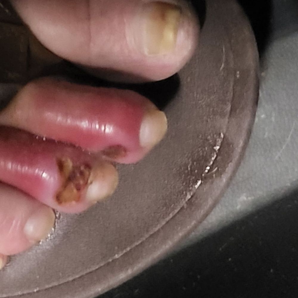 Hi-Tech Nails - This is after 3 days of treatment - Nail Salons Near Me - Bullhead City, Arizona Hi-Tech Nails - This is after 3 days of treatment - Nail Salons Near Me - Bullhead City, Arizona
