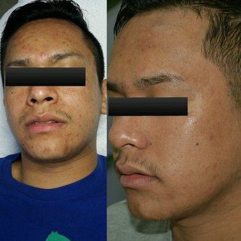Skin Care by MJP - post enzyme/chemical peels - Skin Care Near Me - Chicago, Illinois Skin Care by MJP - post enzyme/chemical peels - Skin Care Near Me - Chicago, Illinois
