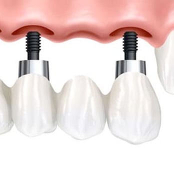 Dental Implant Specialists of Florida - dental implants - Periodontists Near Me - Weston, Florida Dental Implant Specialists of Florida - dental implants - Periodontists Near Me - Weston, Florida