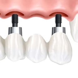 Dental Implant Specialists of Florida - Dental implants