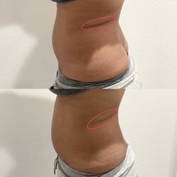 Snatched Cavitation - Before and after one treatment.