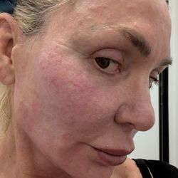 Free & Clear Skin - Right after pico laser for texture