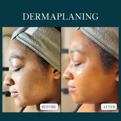 Summer Breeze Salon - Dermaplaning with a Summer Breeze Signature Facial. Fully customized treatment including a Dermaplaning add-on.