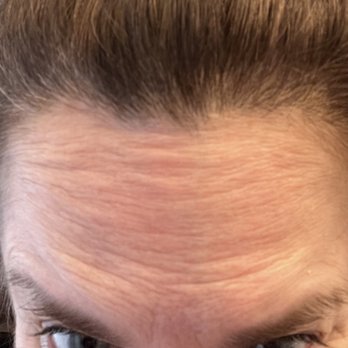 SkinSculpt MedSpa + BodyShaping - Forehead - Medical Spas Near Me - South Ogden, Utah SkinSculpt MedSpa + BodyShaping - Forehead - Medical Spas Near Me - South Ogden, Utah
