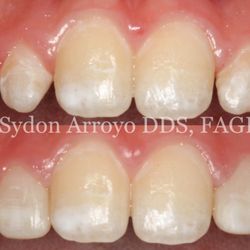 Skypark Dental Professionals - Sydon Arroyo, DDS, FAGD - Changing one smile at a time!
#7 and #10 peg laterals. Restored with chairside veneers.