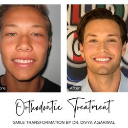 Newport-Mesa Orthodontics & Family Dentistry - Dr. Divya Agarwal corrected Zach's misalignment and overbite, creating a healthier bite and a confident, beautifully aligned smile.