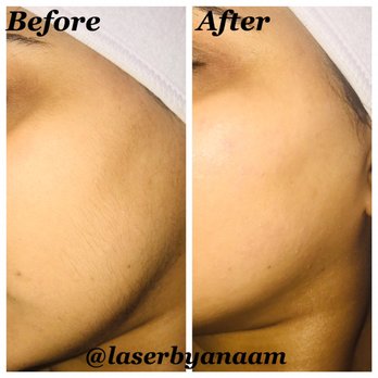 Laser By Anaam - Face Laser Hair Removal Treatment - Laser Hair Removal Near Me - Dearborn Heights, Michigan Laser By Anaam - Face Laser Hair Removal Treatment - Laser Hair Removal Near Me - Dearborn Heights, Michigan