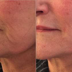 Darab Hormozi, MD FACS - Before and After juvederm lines and lips