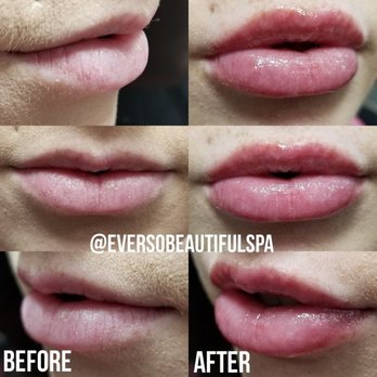 Ever So Beautiful Spa - Needle-less fillers using the hyaluron pen - Permanent Makeup Near Me - Orangevale, California Ever So Beautiful Spa - Needle-less fillers using the hyaluron pen - Permanent Makeup Near Me - Orangevale, California