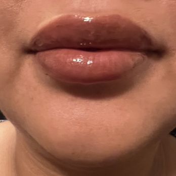 DermFx - right after getting Filler - Medical Spas Near Me - Orange, California DermFx - right after getting Filler - Medical Spas Near Me - Orange, California
