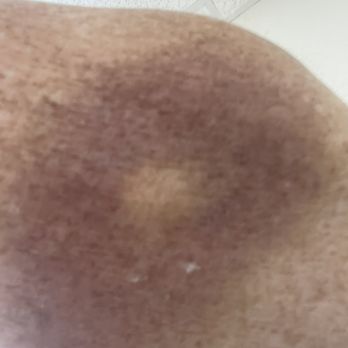 Gulf Coast Medical Center - Bad bruise - Medical Centers Near Me - Spring Hill, Florida