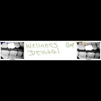 Wellness Dental - The chunky painful blob of a crown put on by Wellness Dental. - General Dentistry Near Me - Austin, Texas