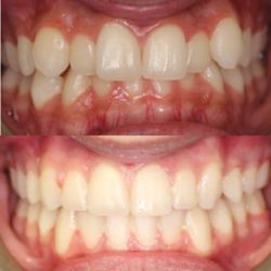 Toothworks of Bakersfield - 6 months express treatment with Dr. B !