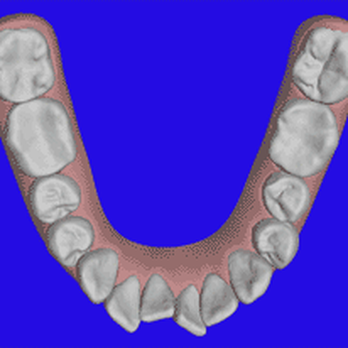 Dentico - Invisalign Simulationsmodell zur Zahnkorrektur - Orthodontists Near Me - Berlin, BE
