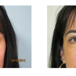 Ocean Plastic Surgery - Before & after photo of an eyelid procedure