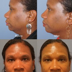 Satyen Undavia, MD - Before and After Non-surgical Rhinoplasty