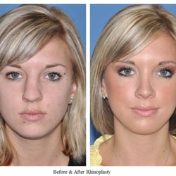 John A Vartanian, MD, FACS - Natural appearing rhinoplasty result, in harmony with the patient's facial features by Dr. Vartanian.