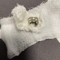 Aloha Family Dentistry Hawaii - My Hawaiian dental tragedy Dec.2023  Crown that cracked and fell out my mouth on my 37th birthday in Hawaii
