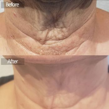 Elite Esthetics - Plasmalift skin tightening (nonsurgical) - Skin Care Near Me - Turlock, California