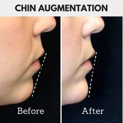 Juvly Aesthetics - chin filler
