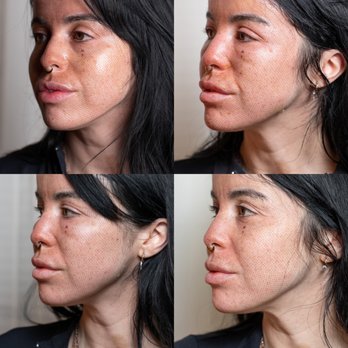 Fibroplasmabeauty - Full face healing - Permanent Makeup Near Me - Pleasant hill , California Fibroplasmabeauty - Full face healing - Permanent Makeup Near Me - Pleasant hill , California