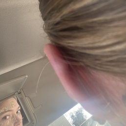 Keloid backside view after Hole Thing removed the pricing they did crooked Keloid backside view after Hole Thing removed the pricing they did crooked