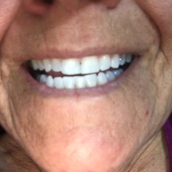 Gently White - Crazy White Teeth - Teeth Whitening Near Me - Rocklin, California Gently White - Crazy White Teeth - Teeth Whitening Near Me - Rocklin, California