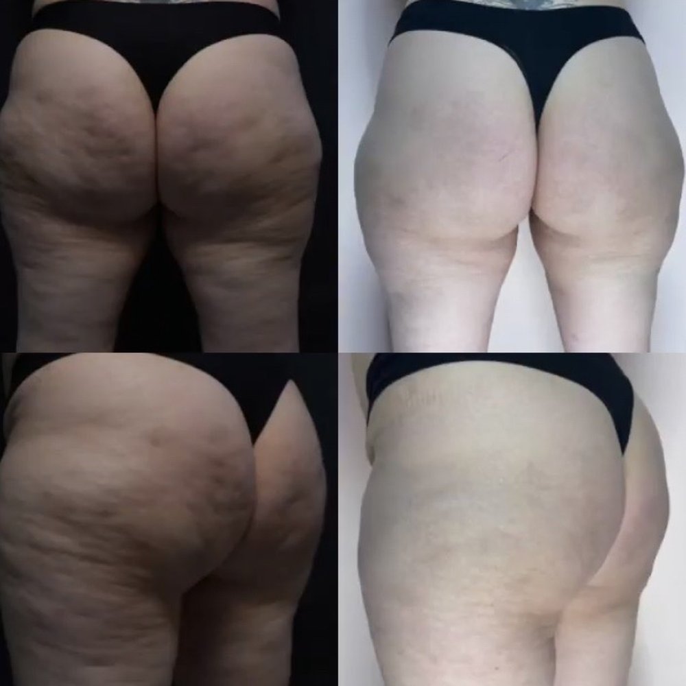 Before and after photos: QWO - injections for Cellulite - Areas treated: buttocks and thighs
