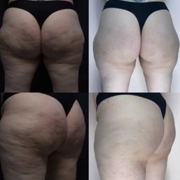 Before and after photos: QWO - injections for Cellulite - Areas treated: buttocks and thighs Before and after photos: QWO - injections for Cellulite - Areas treated: buttocks and thighs