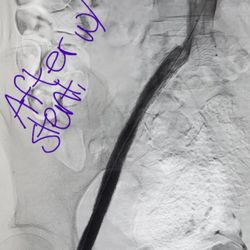 Richard Mooney, MD - How my Stent is supposed to look
