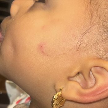 The Goddard School of Middle River - Greenleigh - Bite 2 days after incident - Preschools Near Me - Baltimore, Maryland