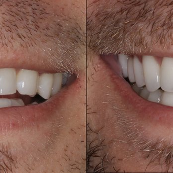 Dr. Jorg-Peter Rabanus - Mike W. Before & After, 2017 - Cosmetic Dentists Near Me - San Francisco, California
