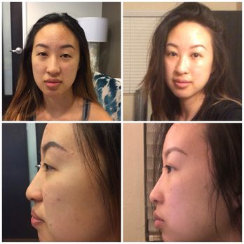 John Park MD Plastic Surgery - Update; before & 9 months - Cosmetic Surgeons Near Me - Newport Beach, California John Park MD Plastic Surgery - Update; before & 9 months - Cosmetic Surgeons Near Me - Newport Beach, California