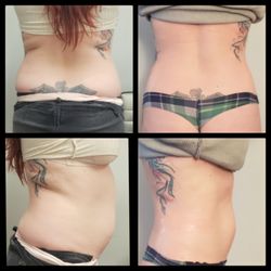 Cavi Spa - Fat reduction and Body Contouring