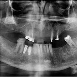 Shiyu Wang, DDS - Nice Dental - 注:
1. 牙齿周围的斑块和钙化,颈动脉分叉处的斑块和钙化,心脏冠状动脉的斑块和钙化,三者有密切相关的正向关系。
2. 颈动脉分叉,在颈椎3与颈椎4之间的高度, 此处最容易出现斑块和钙化。
,