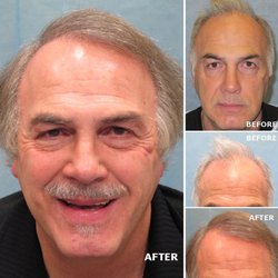 Bernstein Medical - Center for Hair Restoration - Patient BRE had one hair transplant of 2,104 grafts. https://www.bernsteinmedical.com/hair-transplant-photos/portraits/patient-bre/