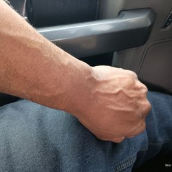 Andi Peshkepija, MD - These bulging veins were used at Henry Ford Fairlane emergency. But no heparin- warfarin given