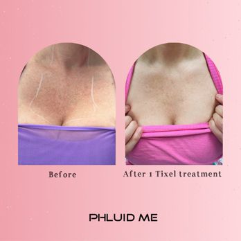 Phluid Medical Esthetics - Before and after Tixel skin resurfacing treatment. - Medical Spas Near Me - Centennial, Colorado Phluid Medical Esthetics - Before and after Tixel skin resurfacing treatment. - Medical Spas Near Me - Centennial, Colorado