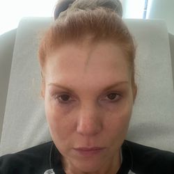 All For YOU MedSpa - Terrible Botox they hit a vein lasted 2 full months never completely went all the way away