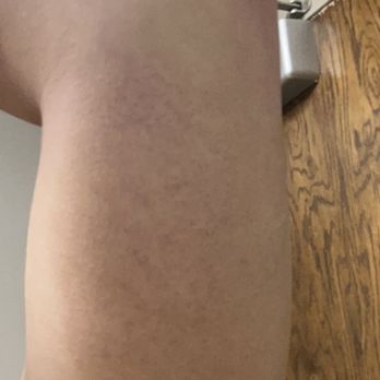 Blue Lotus Tattoo - Huge bruise from 2nd tattoo - Tattoo Near Me - Salem, Virginia Blue Lotus Tattoo - Huge bruise from 2nd tattoo - Tattoo Near Me - Salem, Virginia