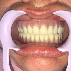 Dentcare - All-on-4  Upper and Lower Arch