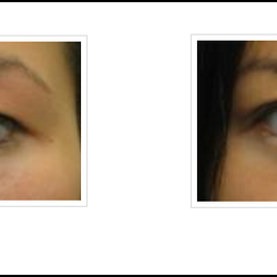 Jeffrey Schiller, MD - Blepharoplasty - Edison, NJ